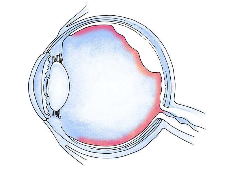 desprendimiento retina ojo