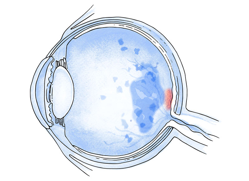 retinopatía diabética ojo