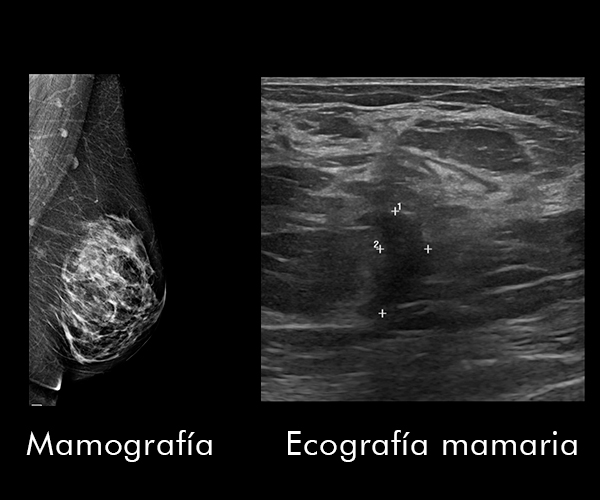 mamografía vs encografia