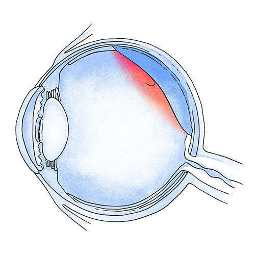 Posterior vitreous detachment