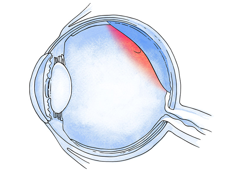 desprendimiento de vítreo posterior