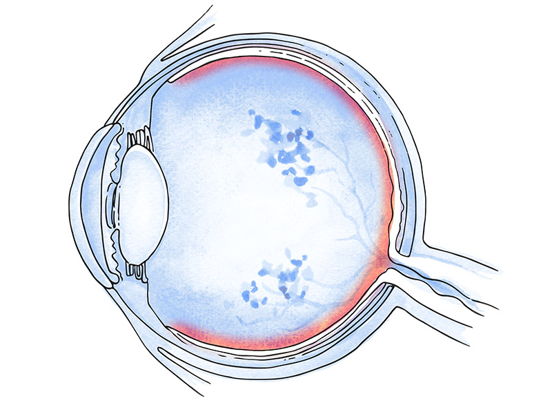 obstrucciones vasculares de retina