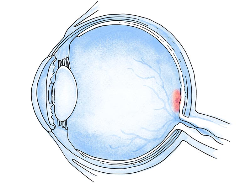 membrana epirretiniana macular