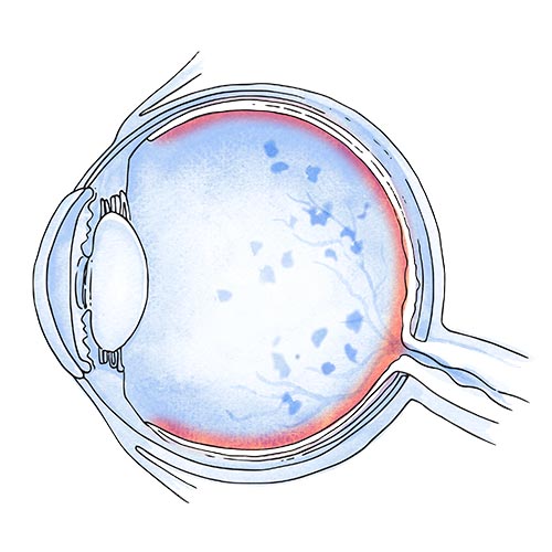 retinosis pigmentaria enfermedad