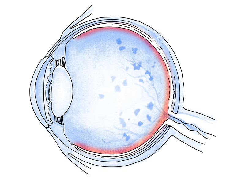 retinosis pigmentaria