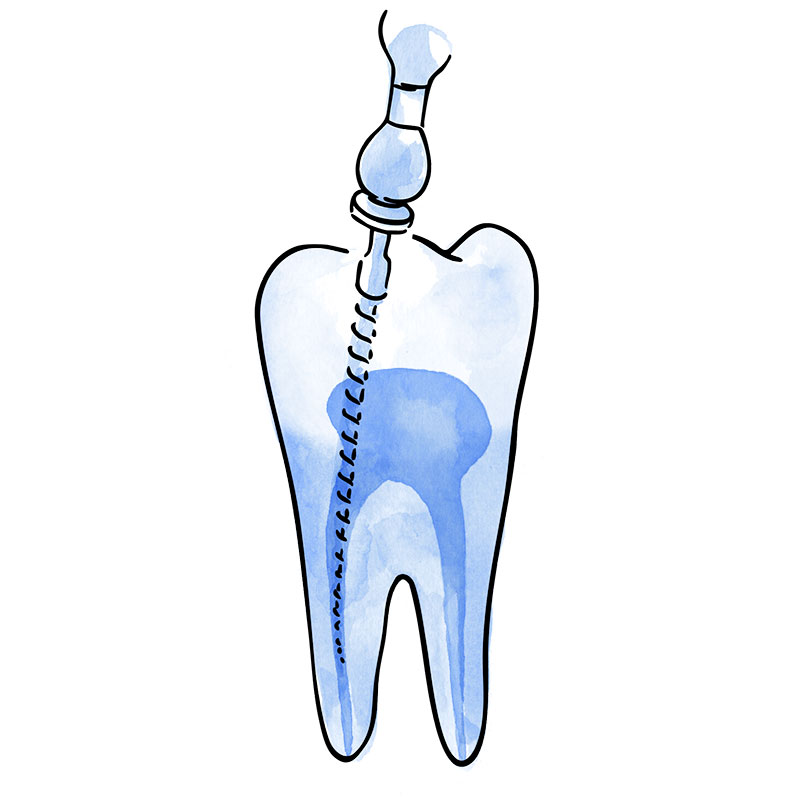 endodoncia dental