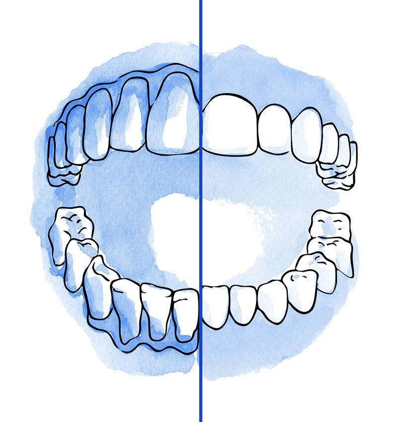 periodontitis